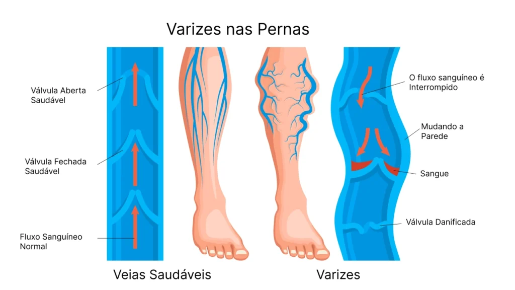 O desenho de uma perna com varizes e outra sem